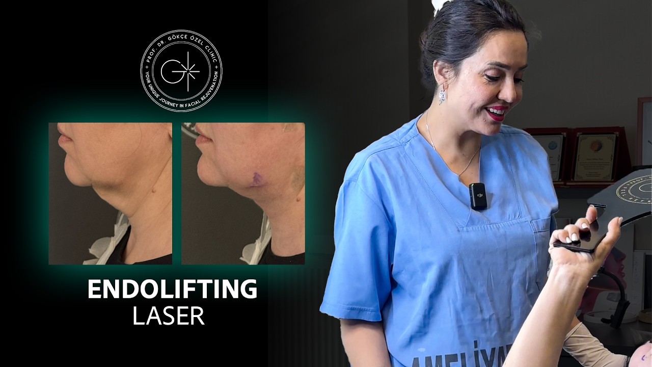 Endolift Sonuçlarımız: Gıdı ve Boyun Sıkılaşmasında Etkileyici Dönüşüm! #endolift #yüzgerme