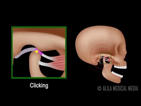 Temporomandibular Joint (TMJ) Anatomy and Disc Displacement Animation
