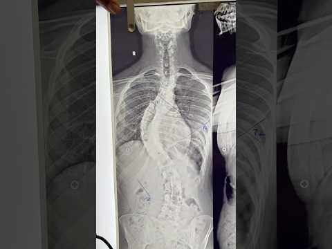 Does scoliosis spine treatment makes spine stiff ?