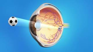Cataract Phaco with Multifocal Lens