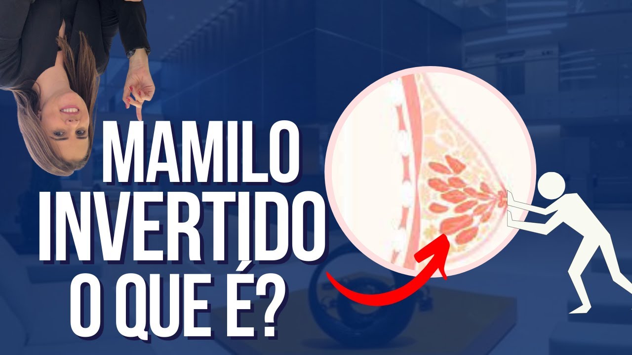 MAMILO INVERTIDO E AGORA ENTENDA O QUE É E COMO PODE SER RESOLVIDO | Dr. Cristian e Dra.Raquel