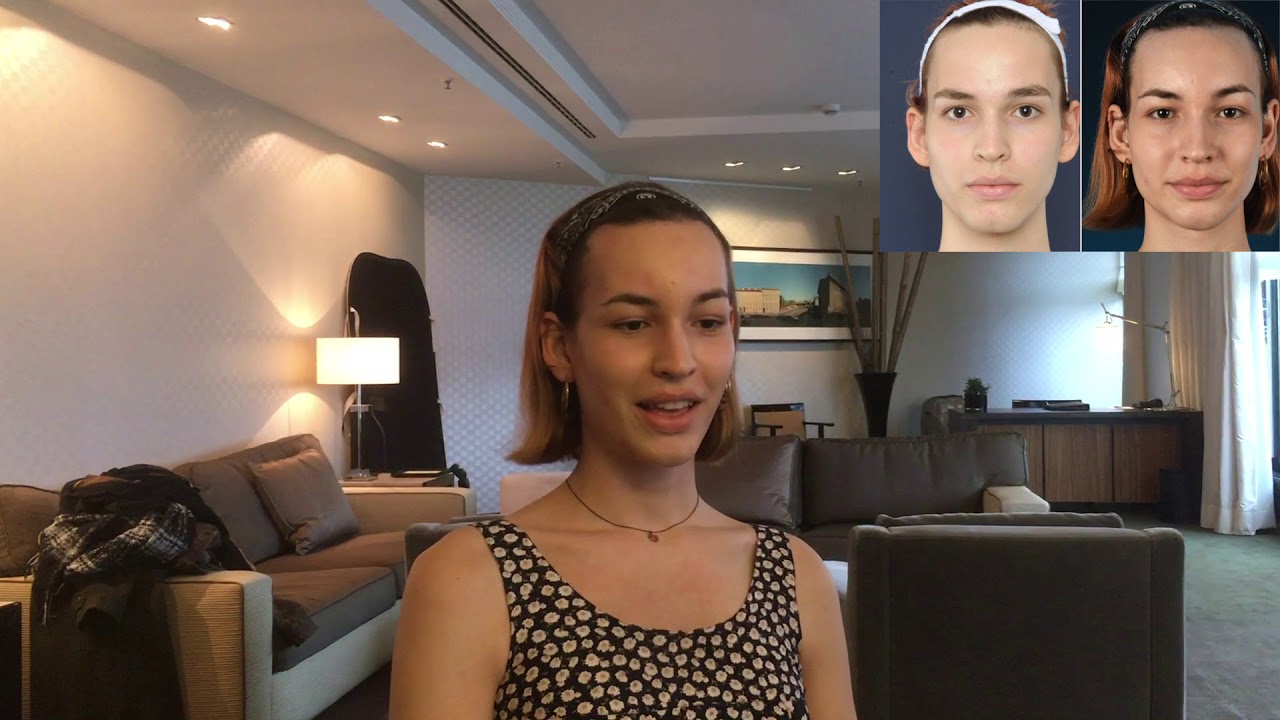 Facial Feminization Surgery Franka