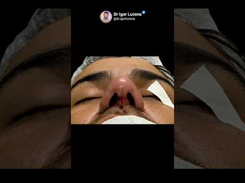 RINOPLASTIA #drigorlucena #consultaonline #rinoplastiabahia #itabuna #ilheus