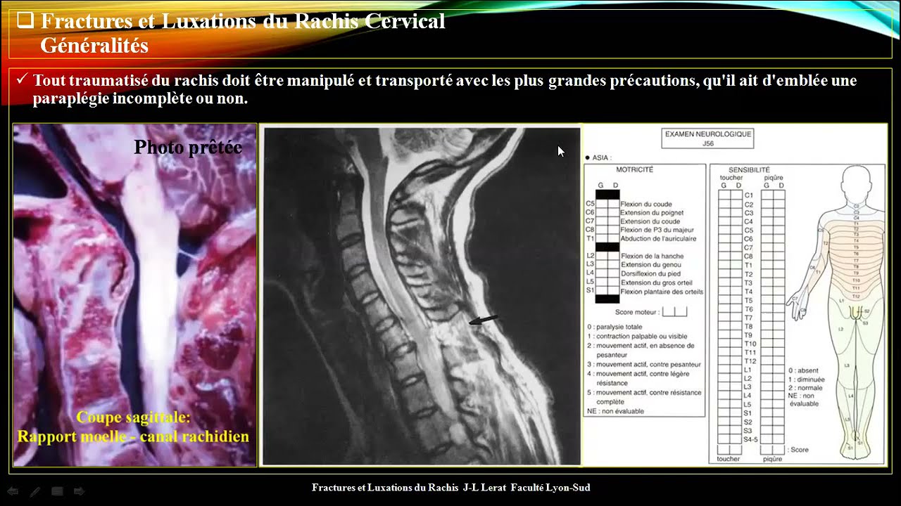 Watch video Traumatisme du rachis cervical ?? meilleure explication ?? par Pr Atia Traumatisme du rachis cervical ?? meilleure explication ?? par Pr Atia
