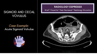 SIGMOID AND CECAL VOLVULUS: Case Example - Acute Sigmoid Volvulus on CT (4530)
