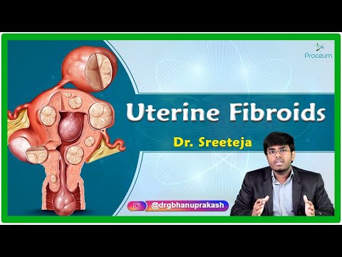 Uterine Fibroids : Causes, Risk factors, Signs and symptoms, Complications, Diagnosis and Treatment