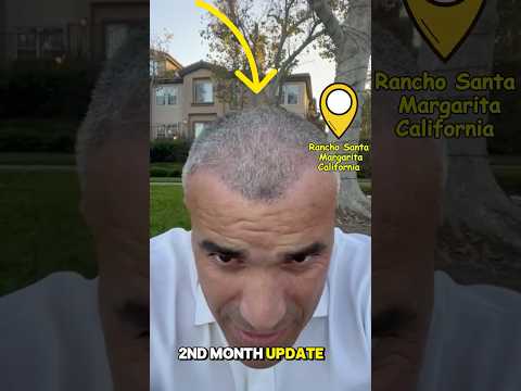 Here’s my Month 2 hair transplant update! #turchcare #hairtransplant #hairrestoration