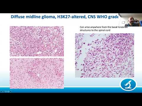 AANP Teaching Rounds - August 24 - Rare Gliomas