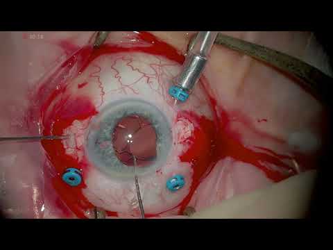 Scleral Fixation & Iridoplasty