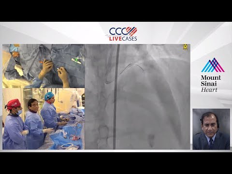 FFR & OCT Guided Staged PCI of LAD Diagonal Bifurcation (Aug 20th)