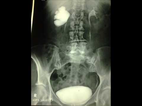 PUJ Retrograde Endopyelotomy Part 1