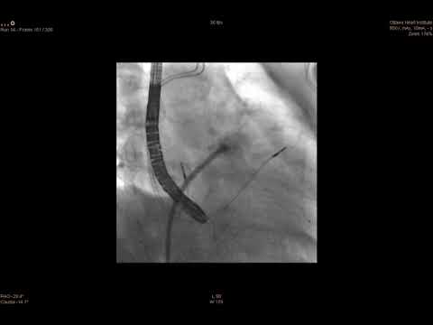 Left atrial appendage closure deployment for managing thromboembolic risk in atrial fibrillation