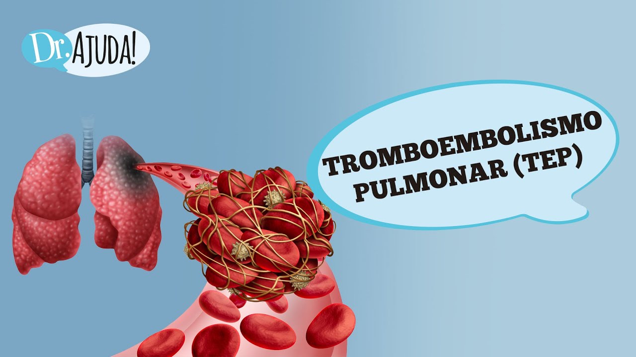 TROMBOEMBOLISMO PULMONAR (TEP):O QUE É?  SINTOMAS E PREVENÇÃO