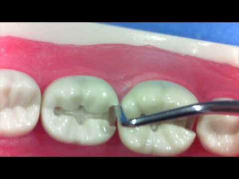 99 Second Tips - Class II Composite to Amalgam Prep Conversion