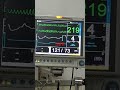 ventricular tachycardia in cardiac monitor