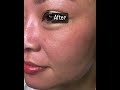 Laser Freckle Removal Dr Peter Kim