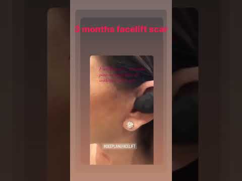 Watch Video: Flawless Results: #3Monthsrecovery Post-Deep Plane Facelift Check-In