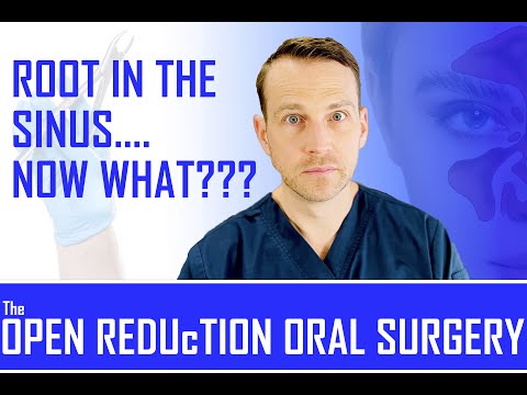 How To Retrieve A Root In The Maxillary Sinus? Displaced Root Retrieval Tutorial