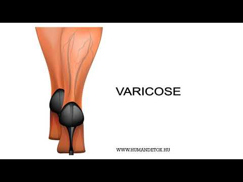 a kezdeti szakasz varikózisának kezelése