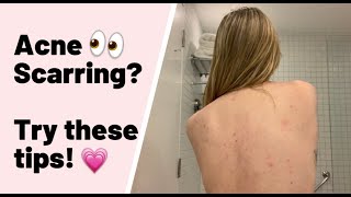 TRY THESE ACNE SCARRING TIPS!😙HELP WITH SKIN PICKING SCARRING💕