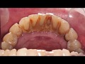 Before And After Scale And Polish Dental Hygienist Telford