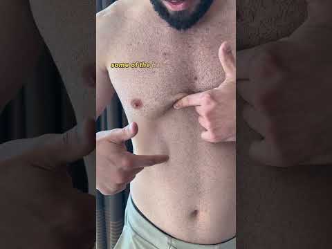 Laser Body Hair Removal! #hairremoval