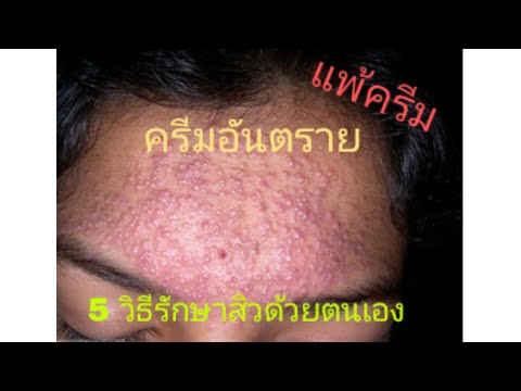 ในคลินิกสำหรับการรักษาของโรคสะเก็ดเงิน pitere โรคสะเก็ดเงิน geptral
