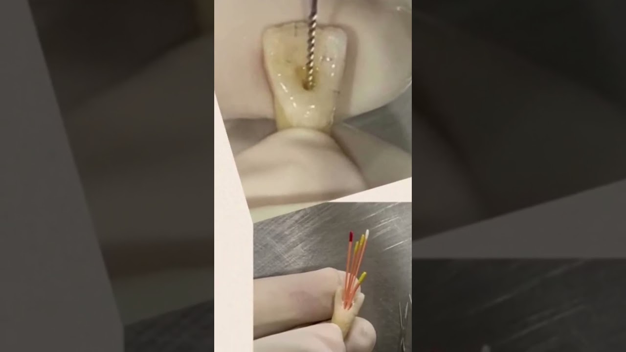 Complete RCT Procedure from beginning to the end