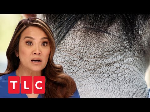Fuchtbar trockene Haut! | Dr. Pimple Popper | TLC Deutschland