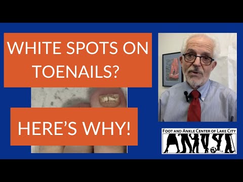 5 Most Common Causes of White Spots on Toenails Foot and Ankle Center