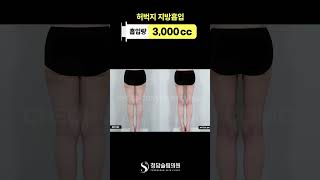 허벅지+엉덩이밑+무릎 지방흡입, 한달차 결과 ☑️