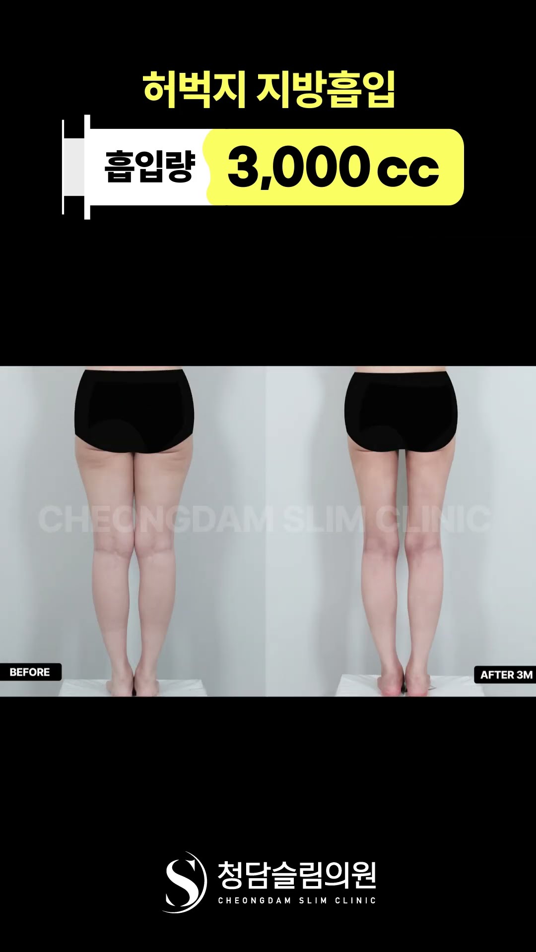 허벅지+엉덩이밑+무릎 지방흡입, 한달차 결과 ☑️