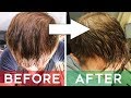 Finasteride Review - Does It Cure Hair Loss? | Finasteride Before and After 8 months
