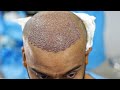Hair Transplant Live Surgery Hair Transplant FUE Technique Best Hair Transplant Results