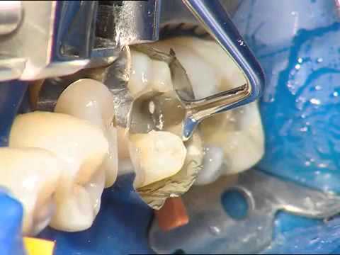 Tetric N Ceram   Ivoclar Vivadent