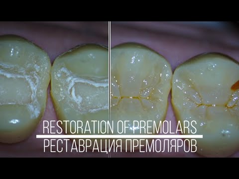 Restoration of maxillary premolars. Виктор Щербаков.