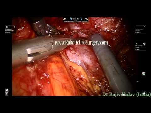 Robotic Surgery For Large Pheochromocytoma