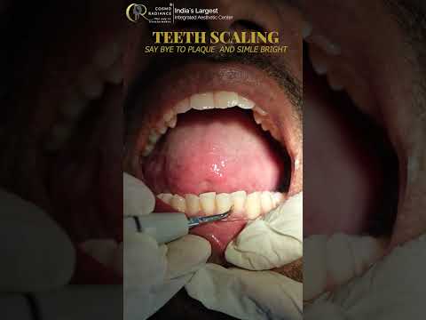 Get a Brighter Smile with Professional Teeth Scaling in Hyderabad | Cosmo Radiance