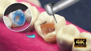 Reconstruccion de muela rota con Resina - no te saques un diente