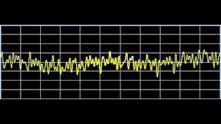 Restless Legs Syndrome - Rife Frequencies