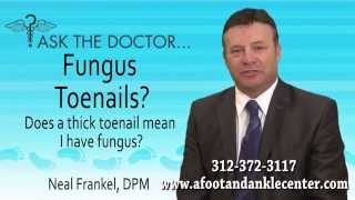 preview picture of video 'Does A Thick Toenail Mean I Have Toenail Fungus? Chicago, Lincolnwood, Oak Brook, IL - Podiatrist'