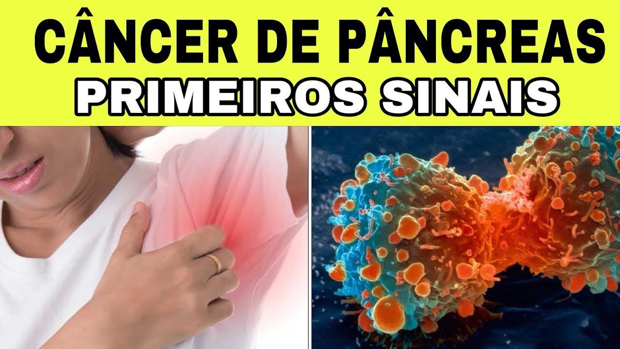 7 Sinais Iniciais de CÂNCER de PÂNCREAS (Sintomas de Insulinoma)