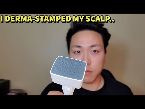 I USED A DERMA STAMP FOR HAIR GROWTH AND THIS IS WHAT...