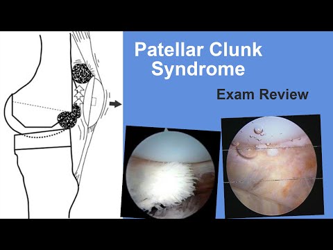 Patellar Clunk Syndrome Exam Review - Matt Austin, MD