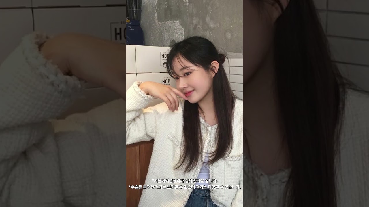 서울아이 코 수술 #자려한 코 #코성형