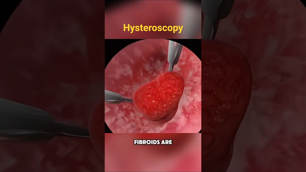 Hysteroscopy Explained: Remove Uterine Polyps & Fibroids Without Surgery!