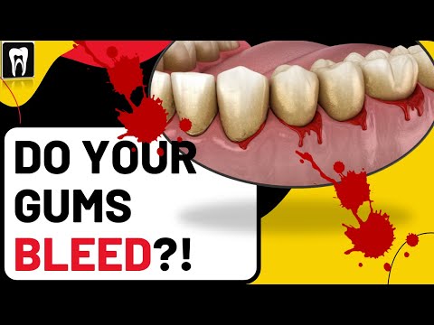 Do You Have Gingivitis or Periodontitis? |Gingivitis and periodontitis|Bleeding gums