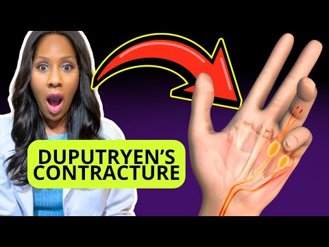 DUPUTRYEN&rsquo;S CONTRACTURE: SYMPTOMS, CAUSES & TREATMENTS. A Doctor Explains