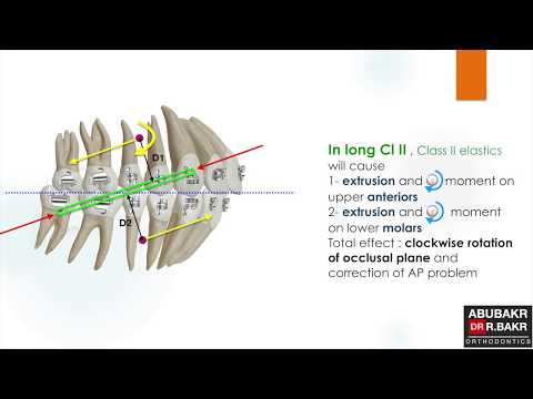 Long and short Class II elastics