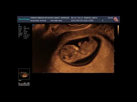 10 semanas de embarazo y mira como estoy vivo!!!!